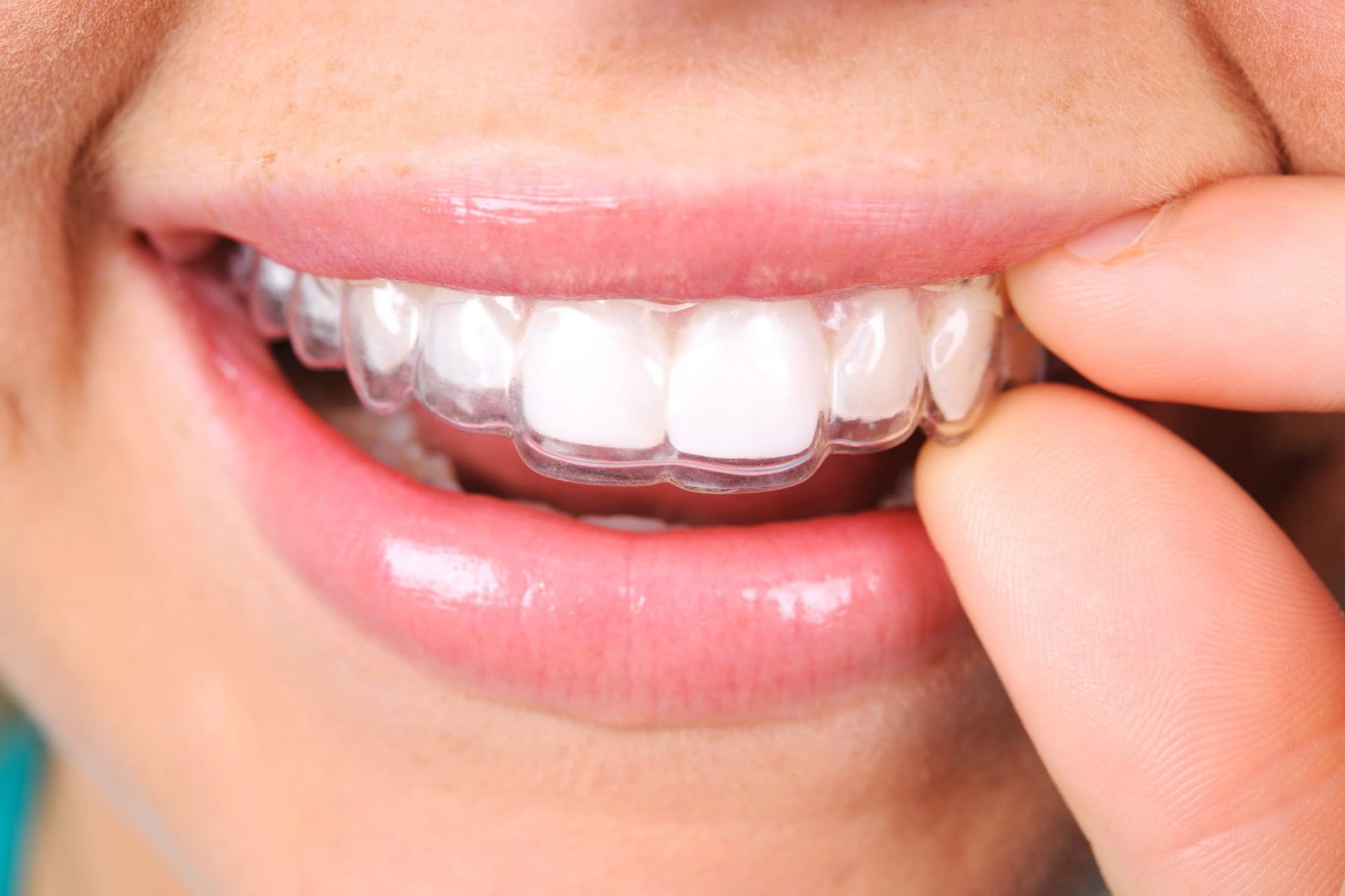 clear correct invisible braces